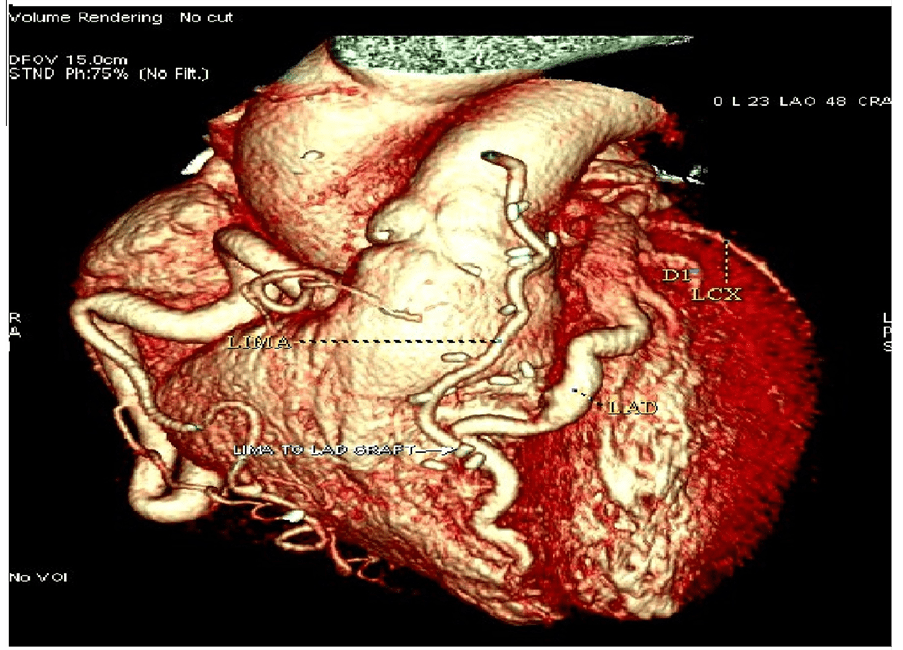 Anomalous Origin of Left Coronary Artery from Main Pulmonary Artery