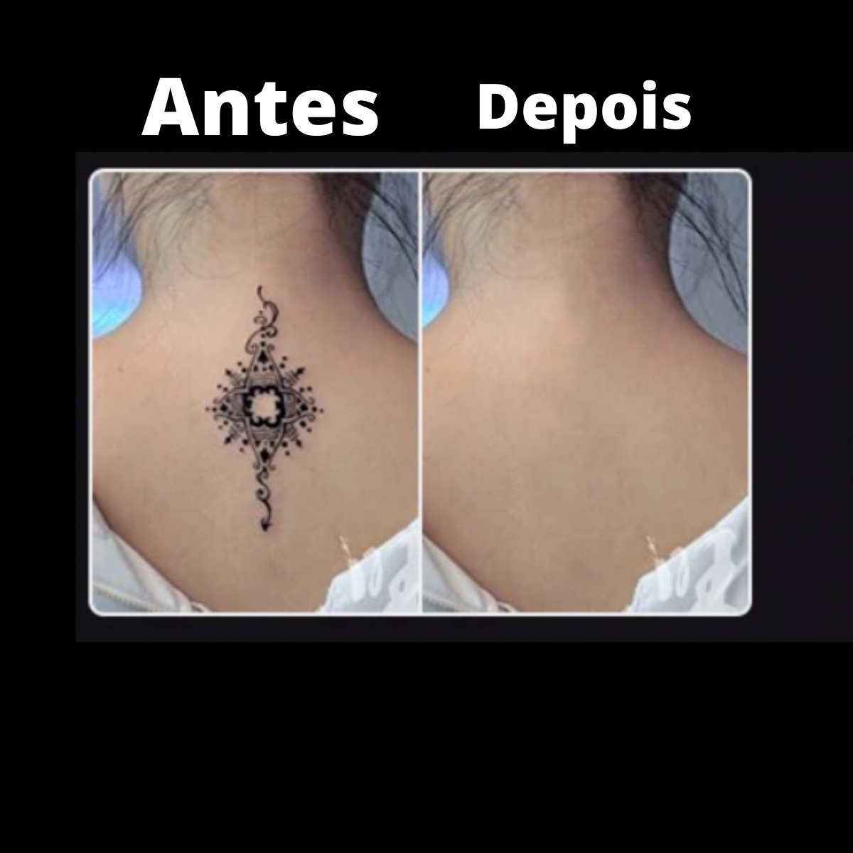 Hell Tattoo Despigmentação a Laser e Tatuagens Remoção De Tatuagens à Laser Remover Tatuagem Manual Português Profissional Mercado Livre