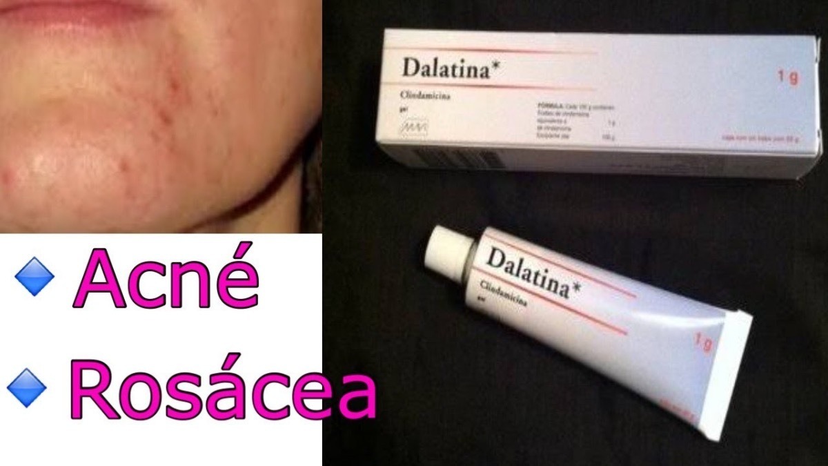 Gel Facial Elimina Acne Barros Espinillas Clindamicina 1 FARMACIAS BS