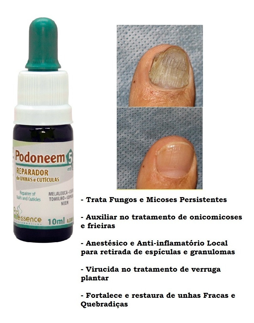 Podoneem Micose De Unha Tratamento Intensivo Líder De Vendas Mercado