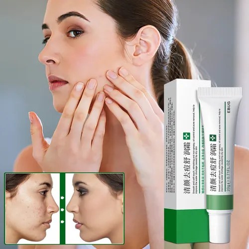 B6 Clear Rosto E Creme Para Aliviar A Acne, Fade Acne Marks