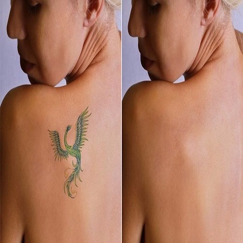 Bem Estar Tatuagem pode ser removida pouco tempo depois de feita, diz Aprenda O Segredo De Remover Tatuagem Sem Laser E Sem Dor R 49,90 em