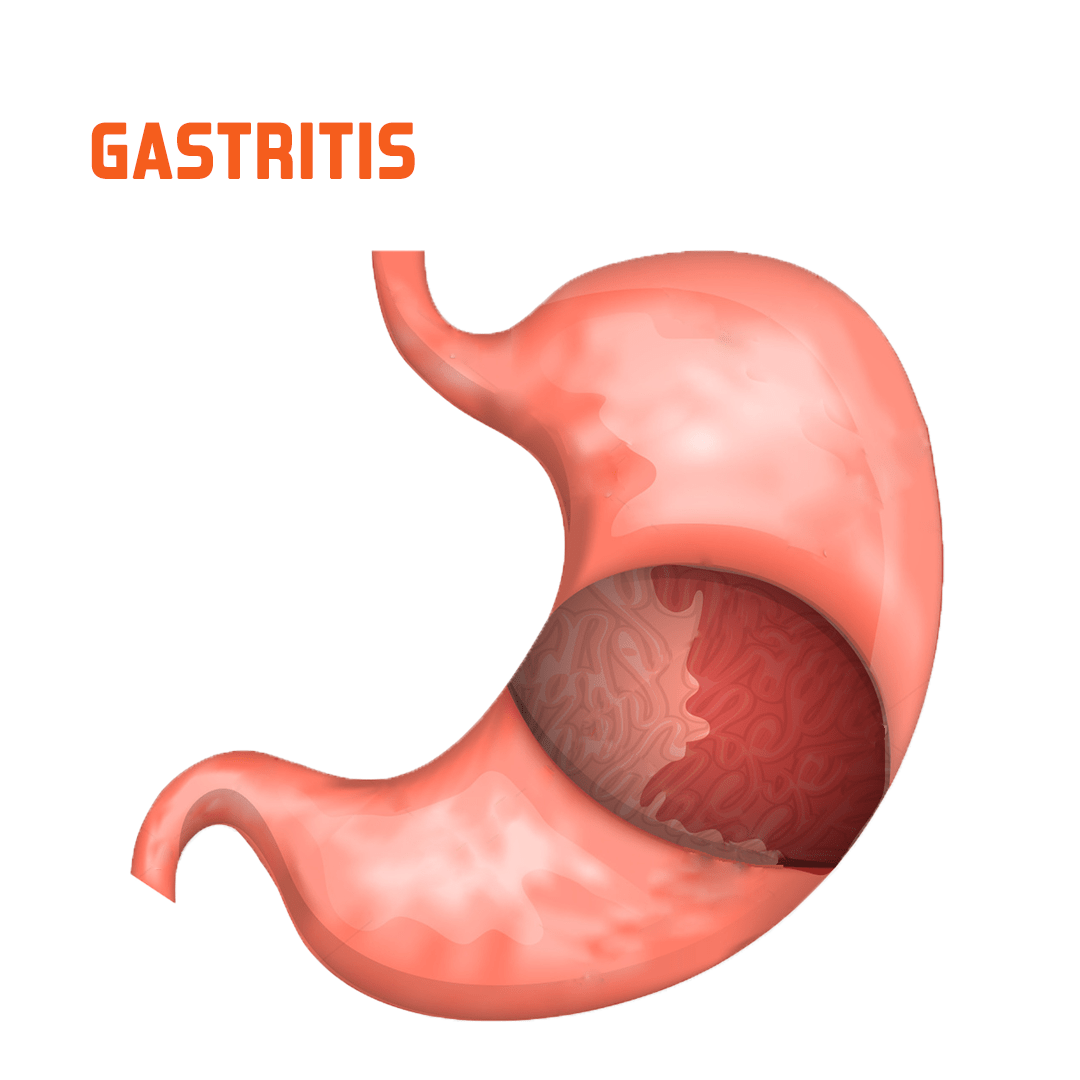Gastritis Cynthia Chacon Osorio