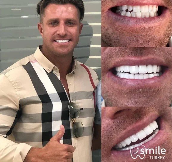 Veneers in Turkey InDepth Guide for Patients