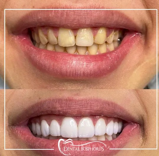 Dental Veneers Review Key Pros and Cons Bookimed