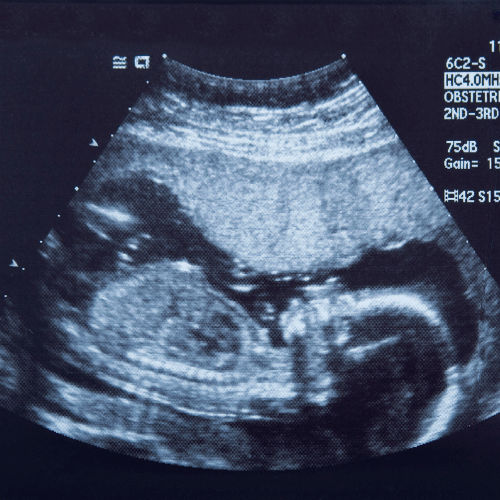 NonInvasive Prenatal Testing HudsonAlpha Institute for