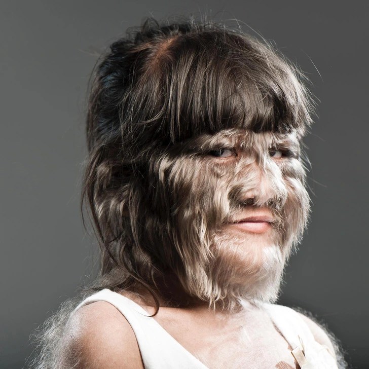 The world’s hairiest girl has grown up, is happily married, and is now