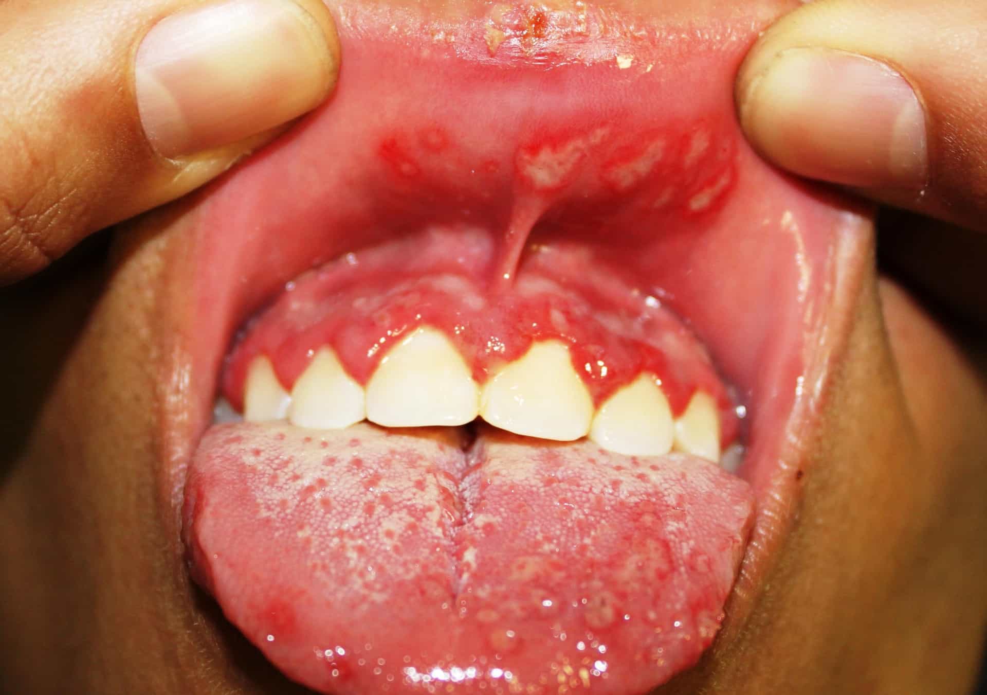 Koortslip / Herpes Labialis - Huidarts.com