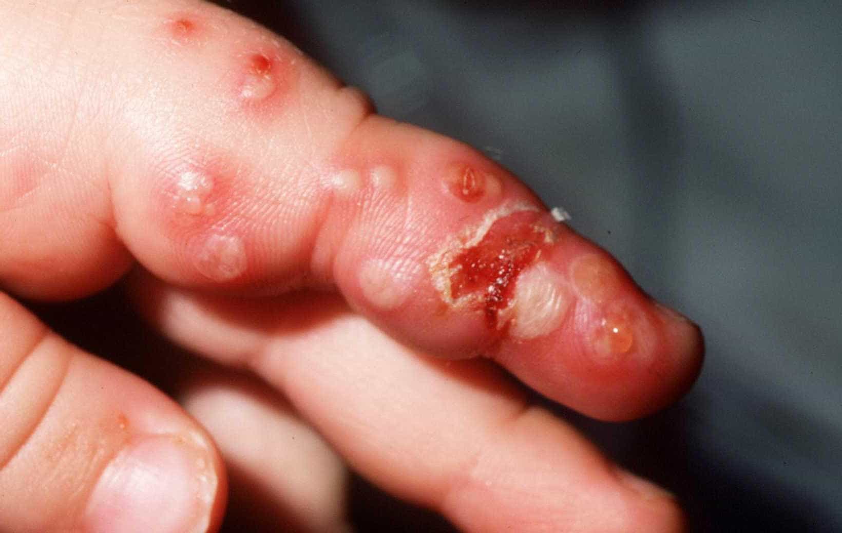 Koortslip / Herpes Labialis - Huidarts.com