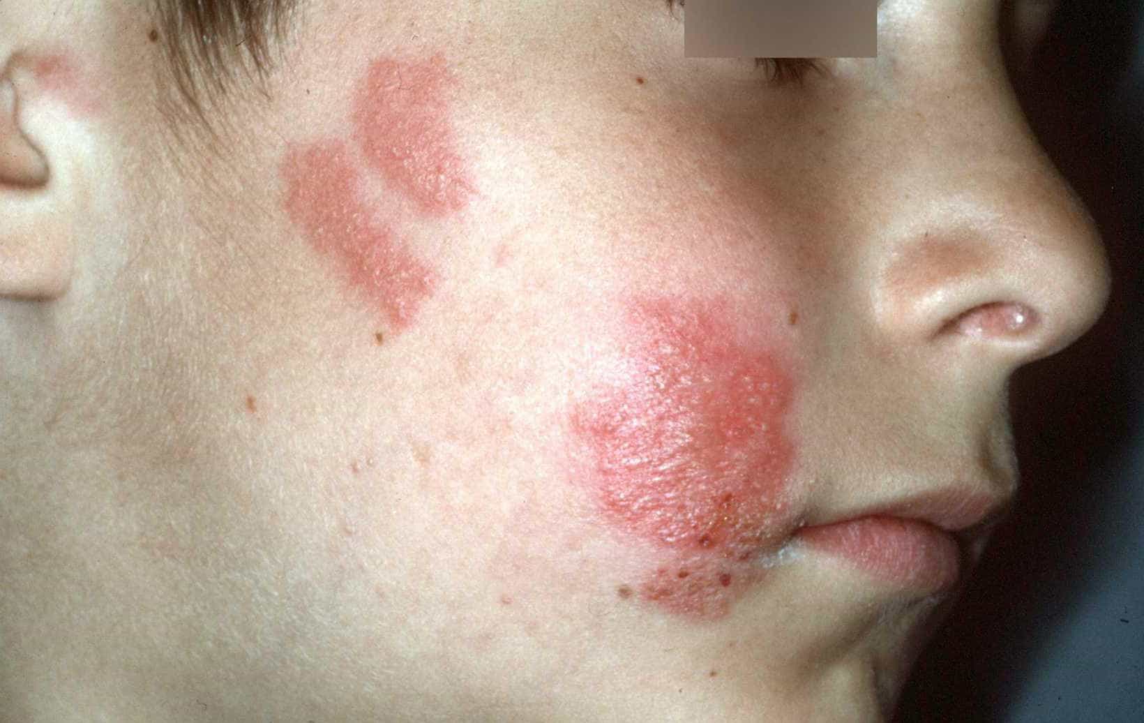 Koortslip / Herpes Labialis - Huidarts.com