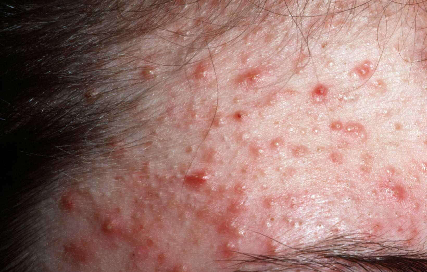 Mee-Eters - Huidarts.com