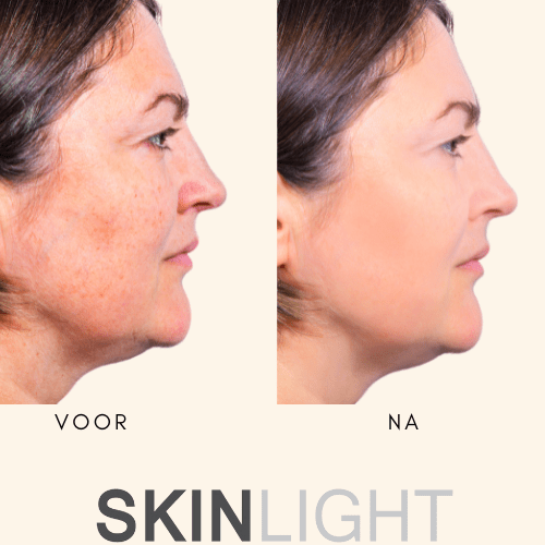 Pigment- Ouderdomsvlekken Verwijderen | Afkomen Van Handvlekken