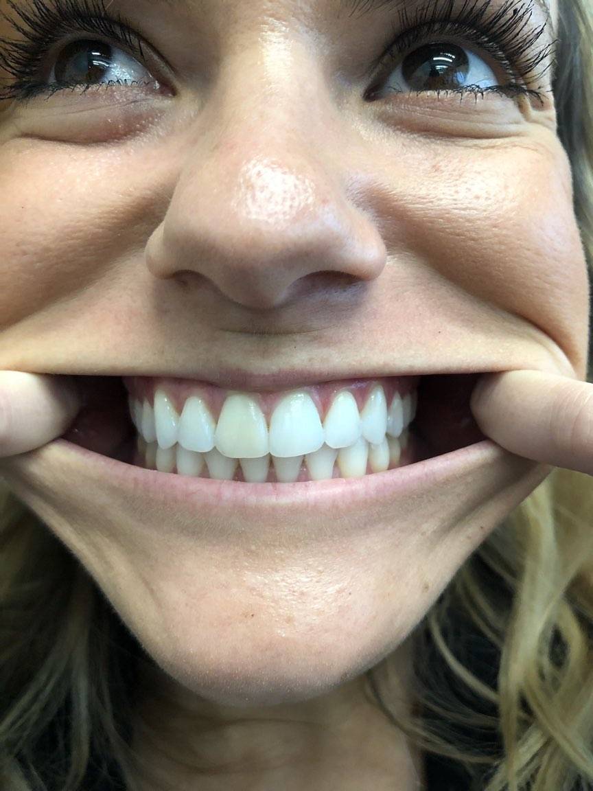 Virtual Smile Assessment for Braces Hulse Orthodontics Carlsbad, CA