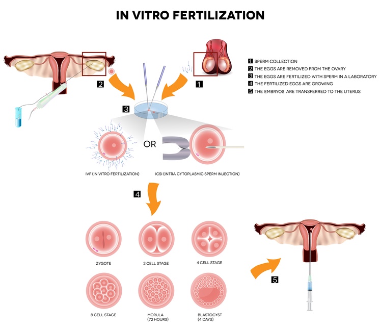 In Vitro Fertilisation (IVF)