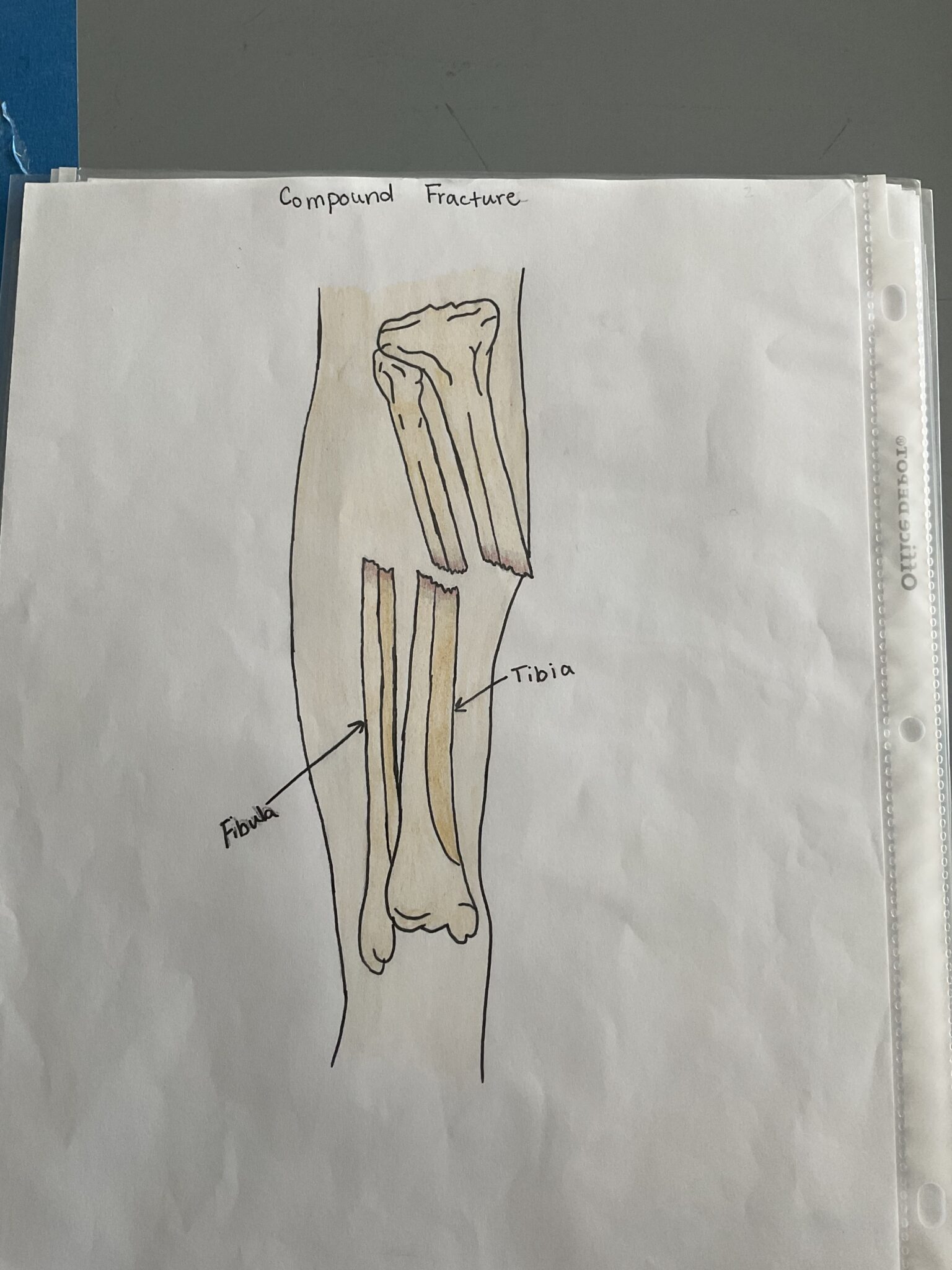 The Healing process of the Compound Fracture with Metal Plates Human