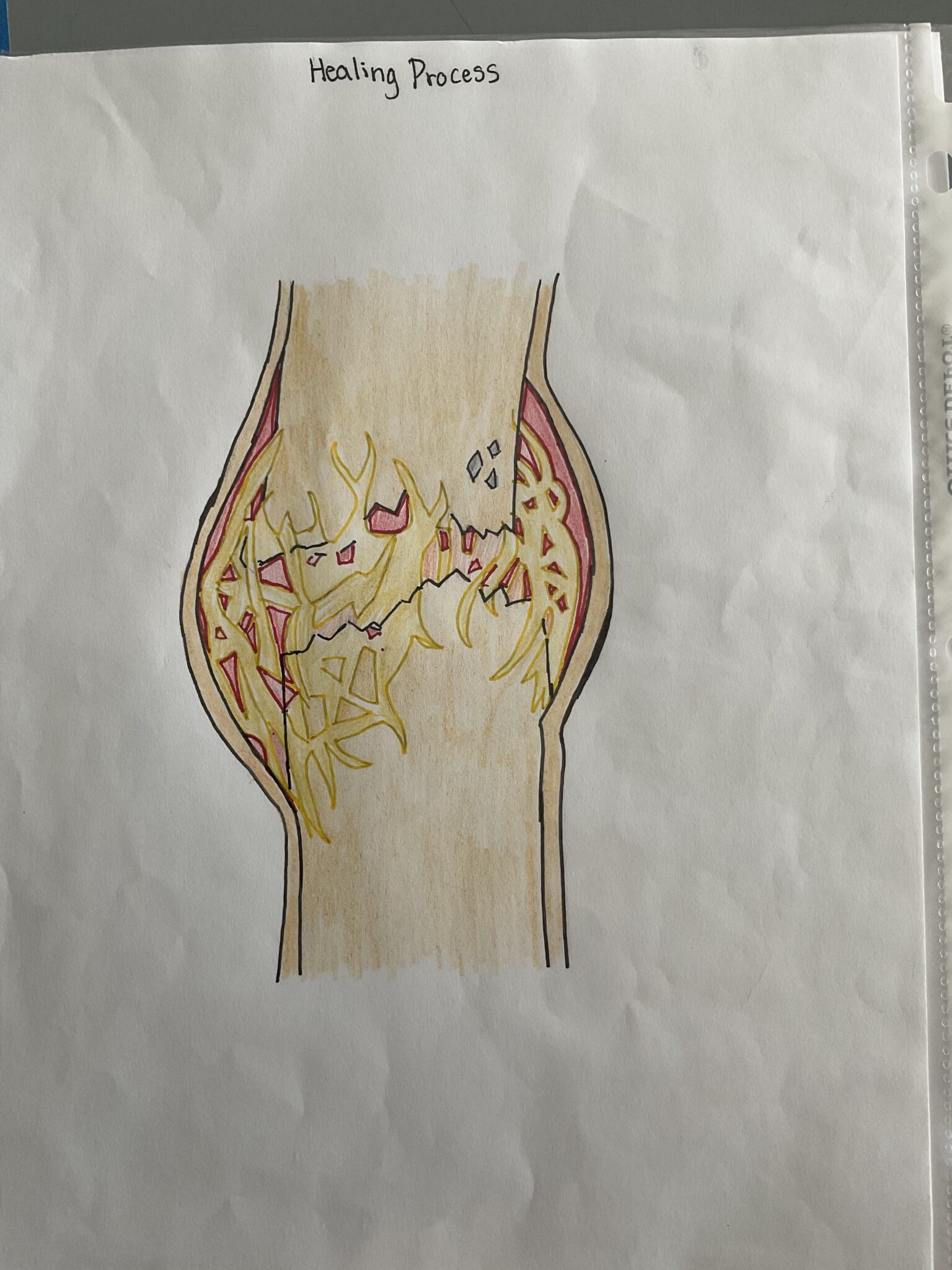 The Healing process of the Compound Fracture with Metal Plates Human