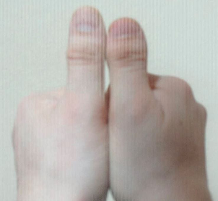 People With Clubbed Thumbs Will Get These 12 Photos