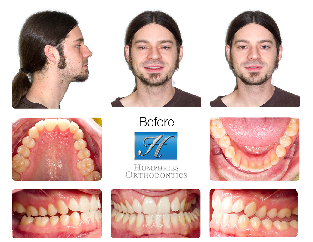 Humphries Orthodontics High Quality Patient Oriented Orthodontic Care