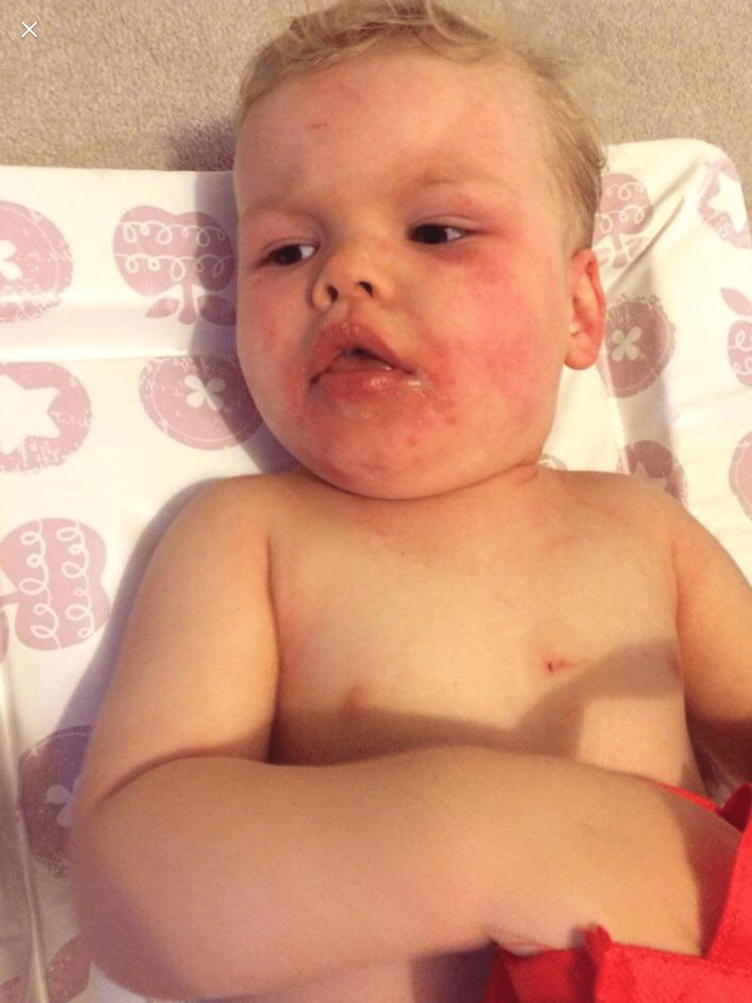 Baby Eczema Skin Conditions Hydranure Cream at £14.99