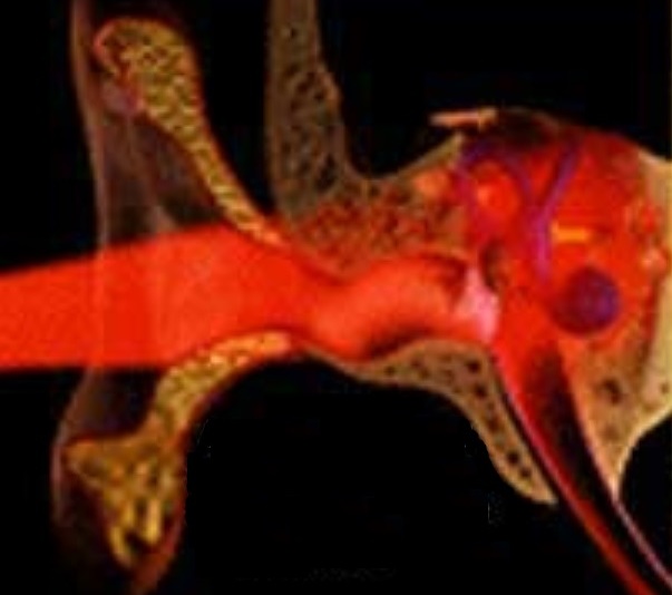 Lowlevel Laser Therapy One Patient’s Experience Hyperacusis Research