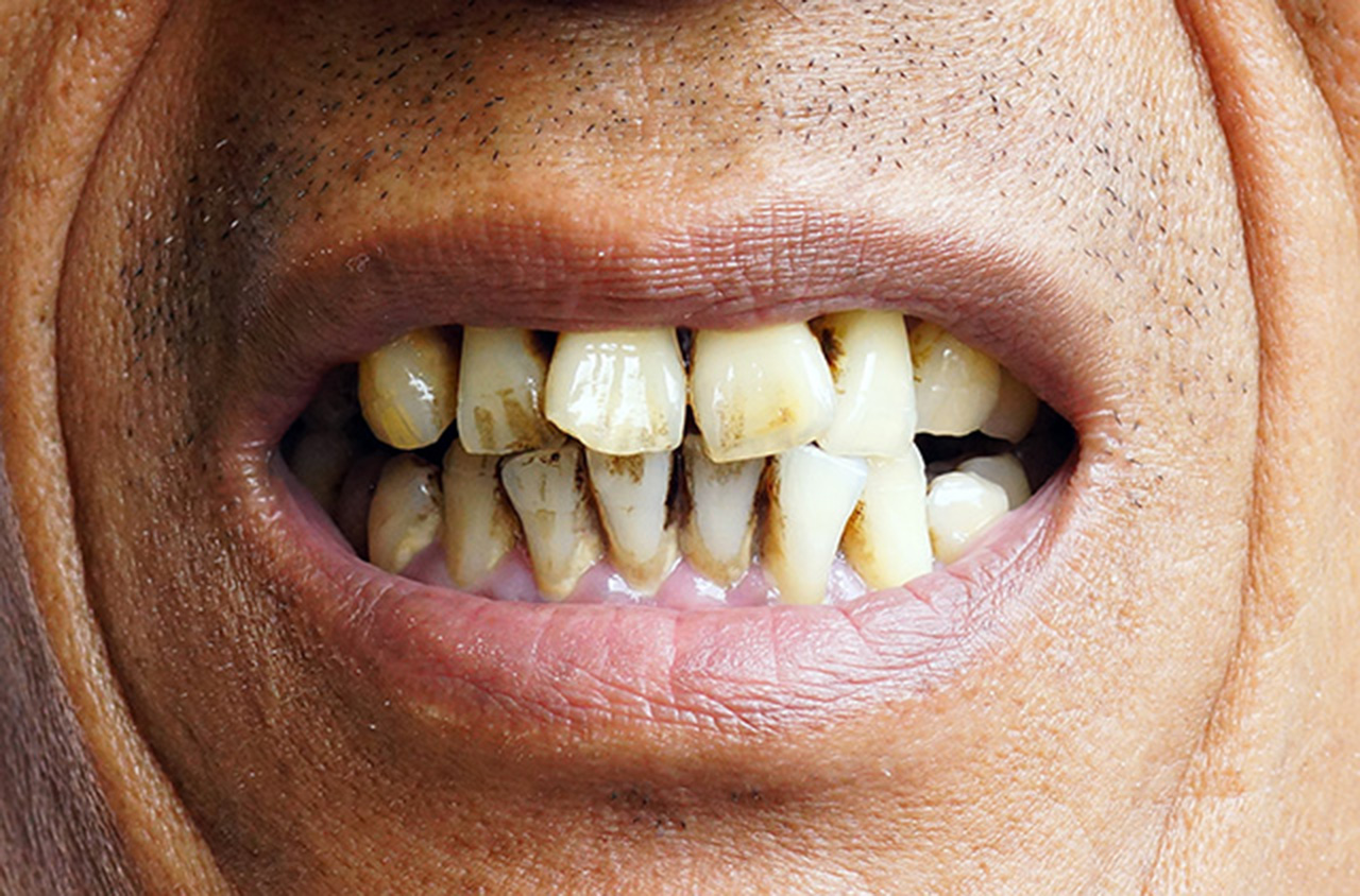 Effective Tooth Decay Remedy Hyster Home