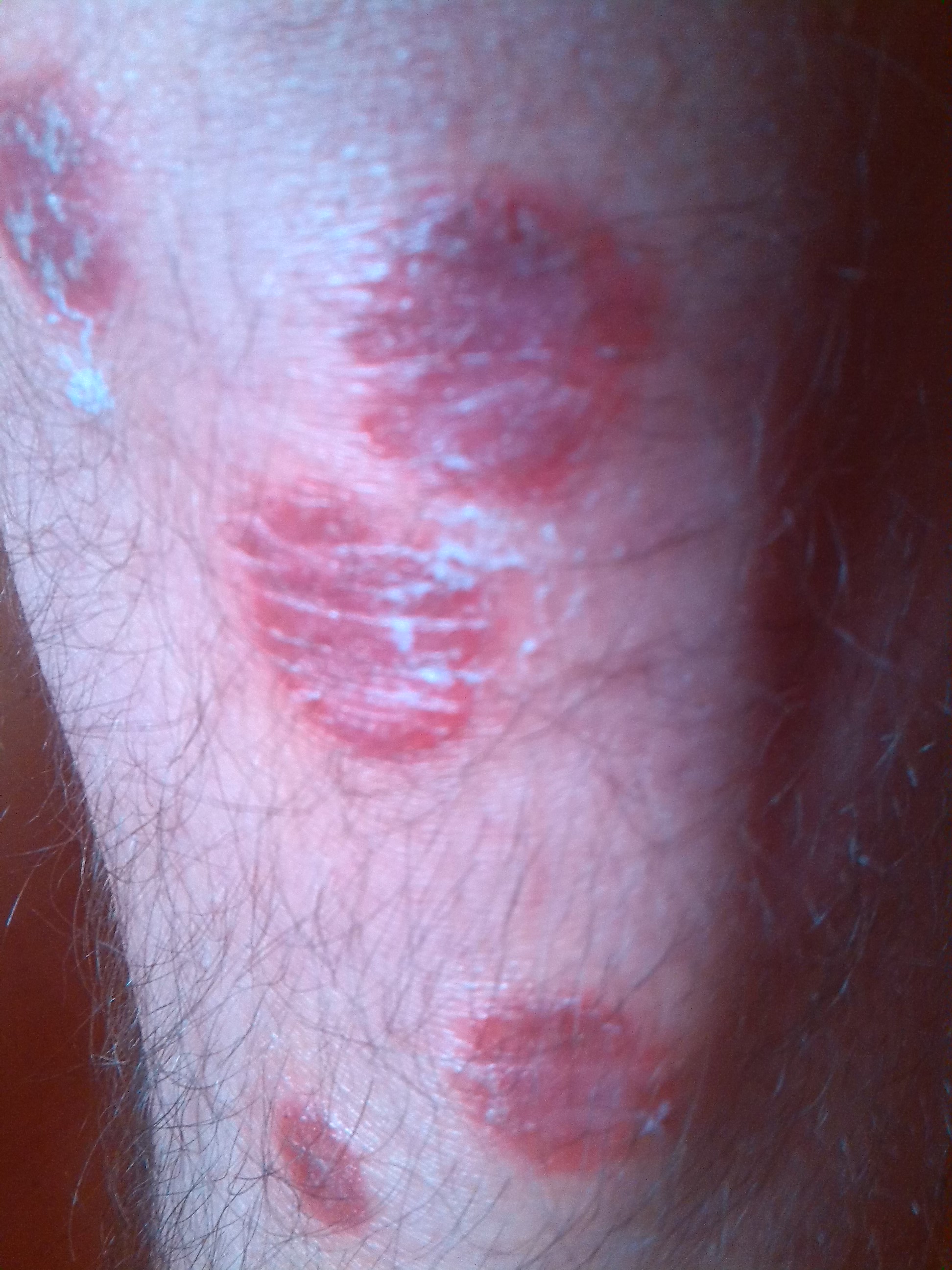 Psoriasis oder Hautpilz ? Schuppenflechte