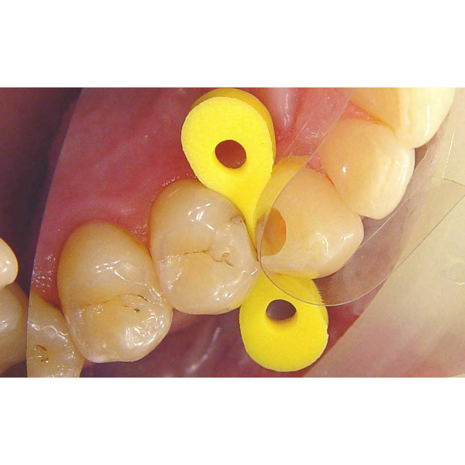 Elastic Wedges for Dental Matrix System Restoration 40pcs set