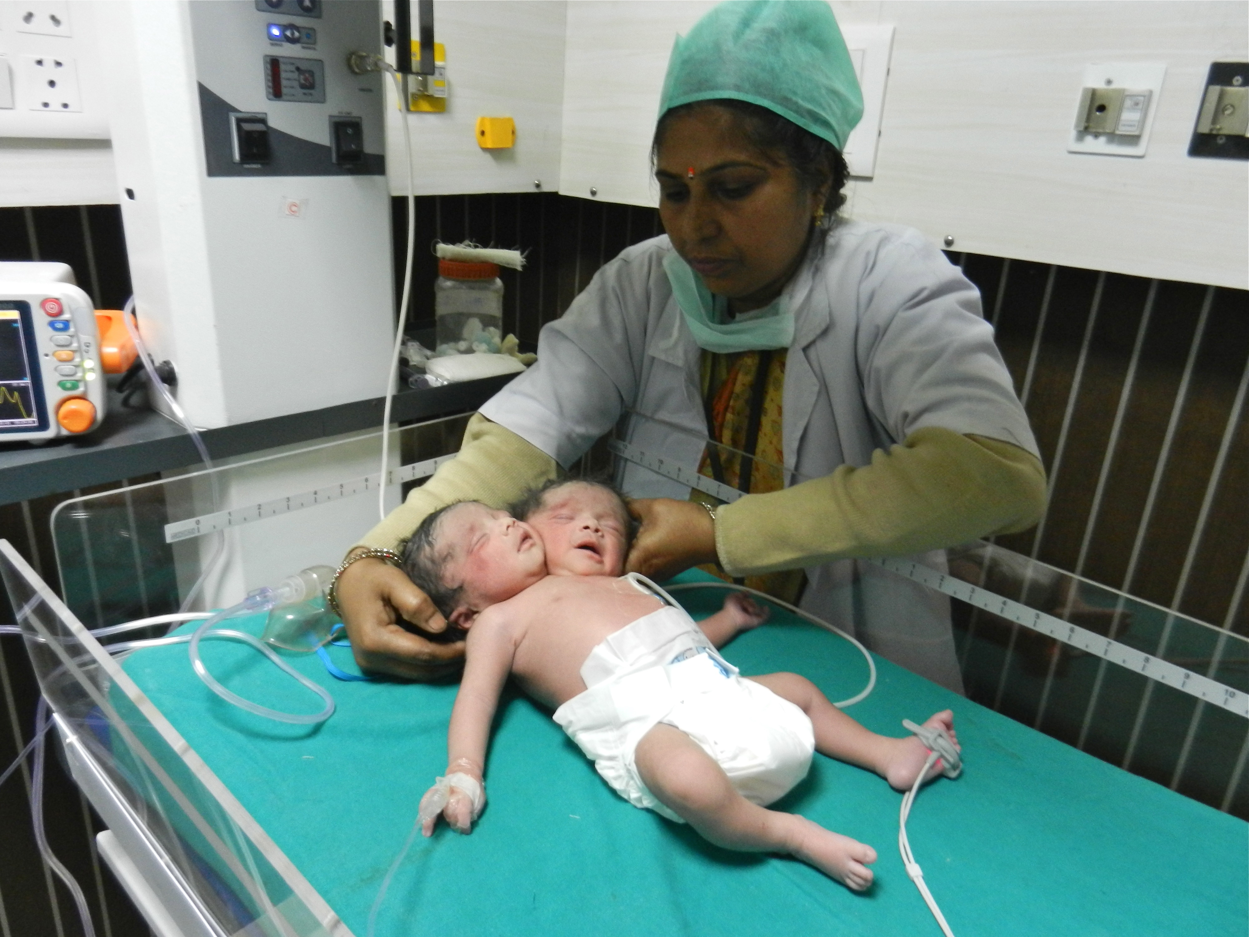 'Female Baby Having Two Heads' Born In India HuffPost