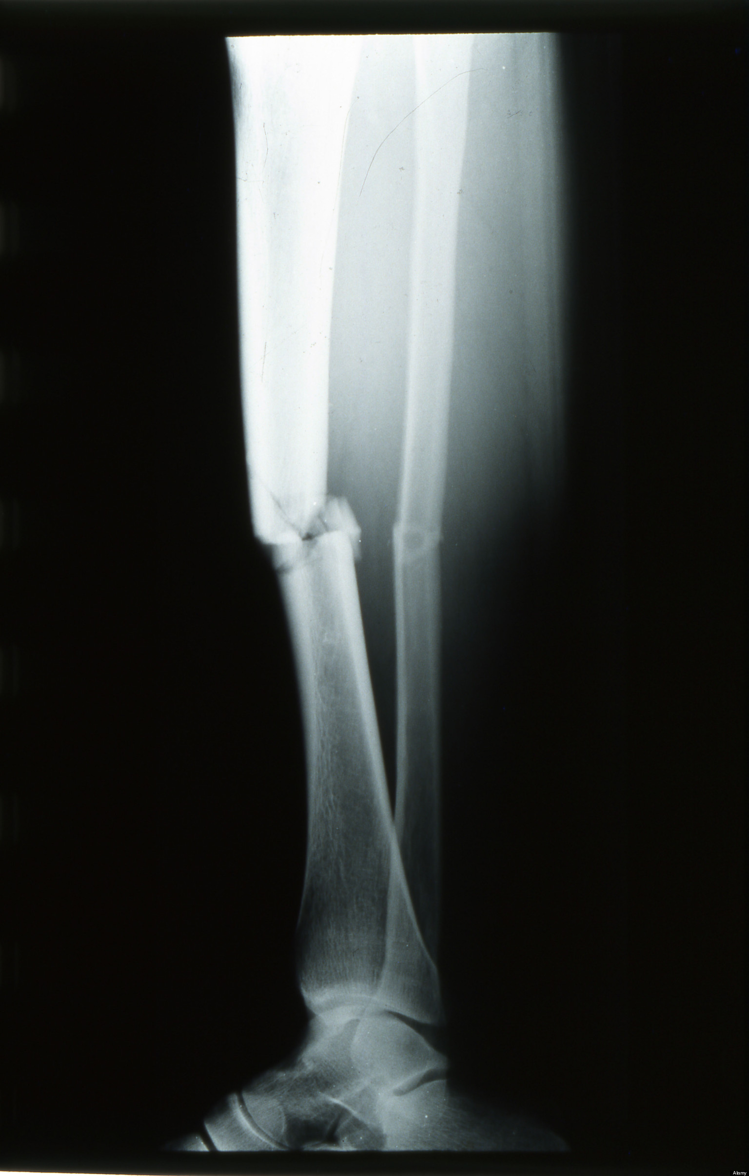 Ultrasound Treatment To Heal Bone Fractures Approved By NHS HuffPost UK