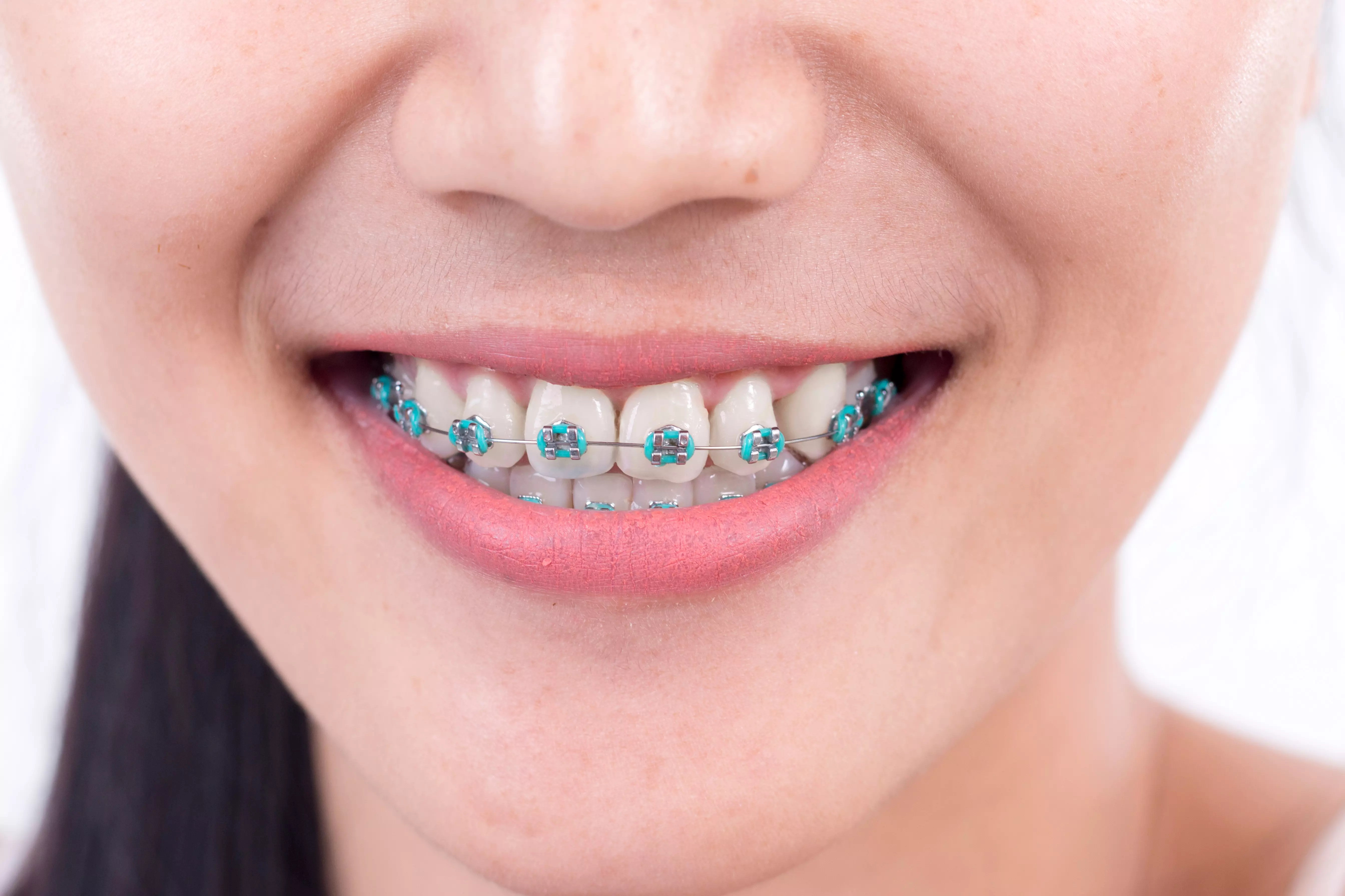 Happy Hour Local Orthodontist to Give Away Braces