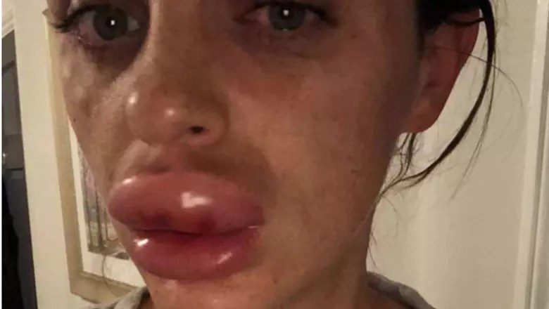 Woman Almost Lost Her Lip After Botched Injection At Botox Party