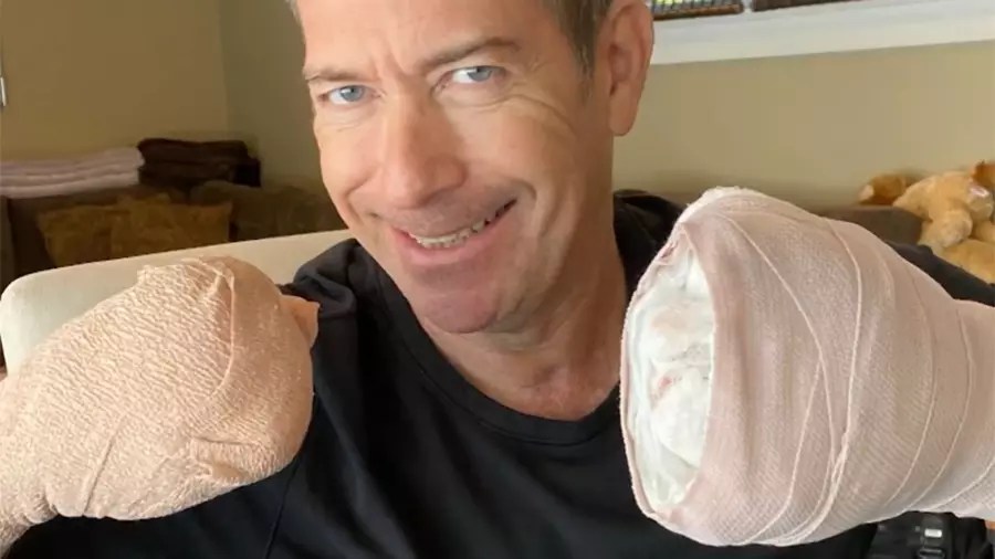 California Man Loses His Fingers Following TwoMonth Battle With COVID