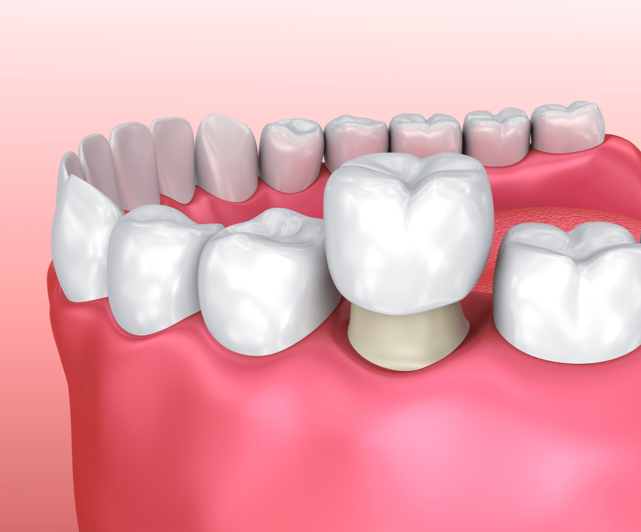 tooth crown dentist Blank Template Imgflip