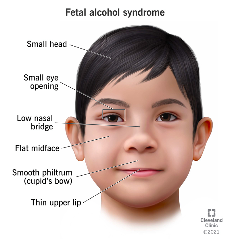 Fetal Alcohol Syndrome Blank Template Imgflip