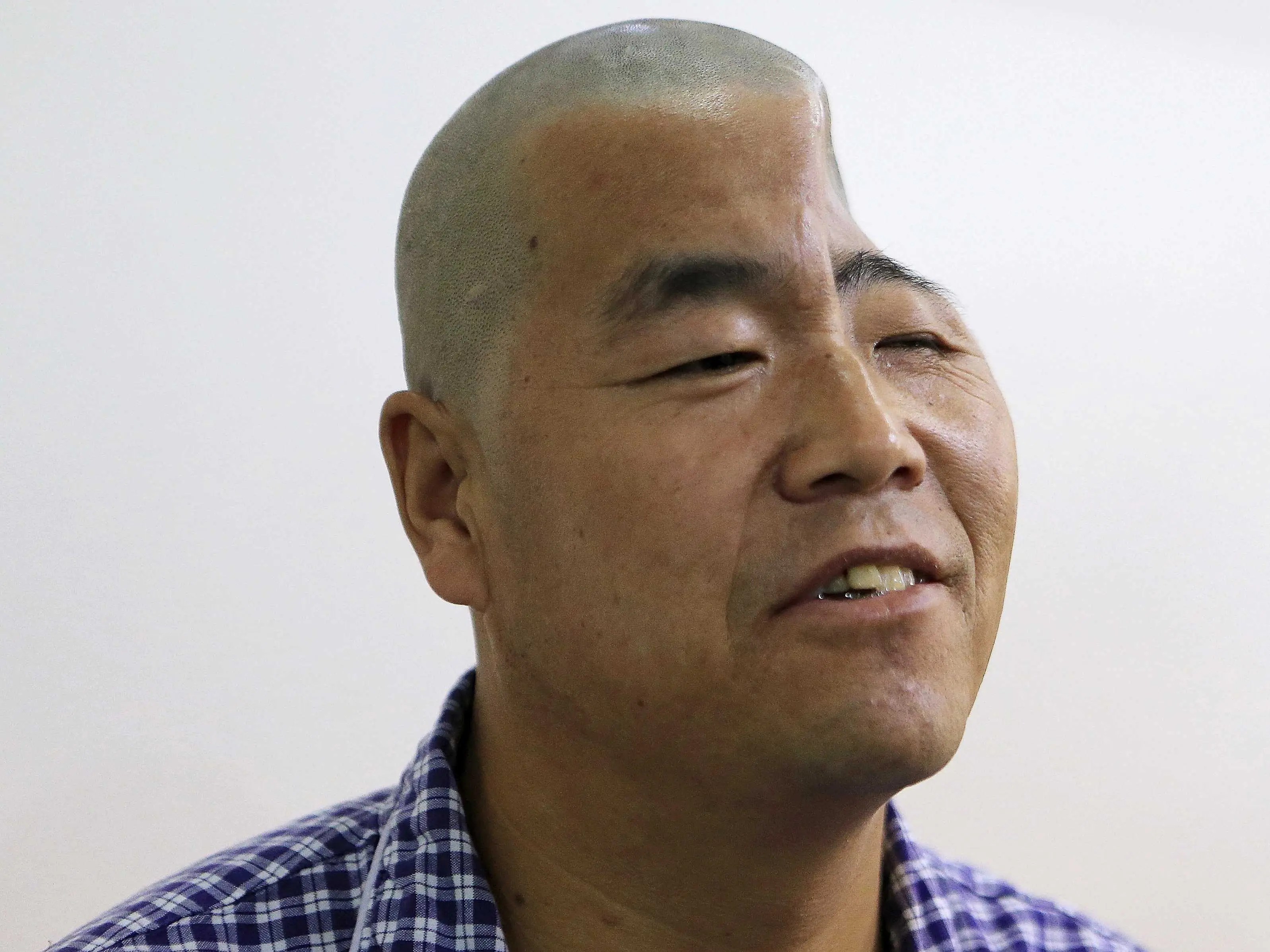 3D Printed Titanium Skull in Chinese Man Business Insider