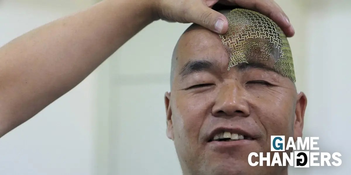 3D Printed Titanium Skull in Chinese Man Business Insider