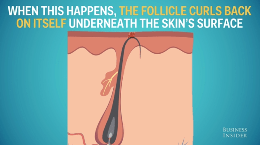 The science of why you should treat ingrown hairs Business Insider
