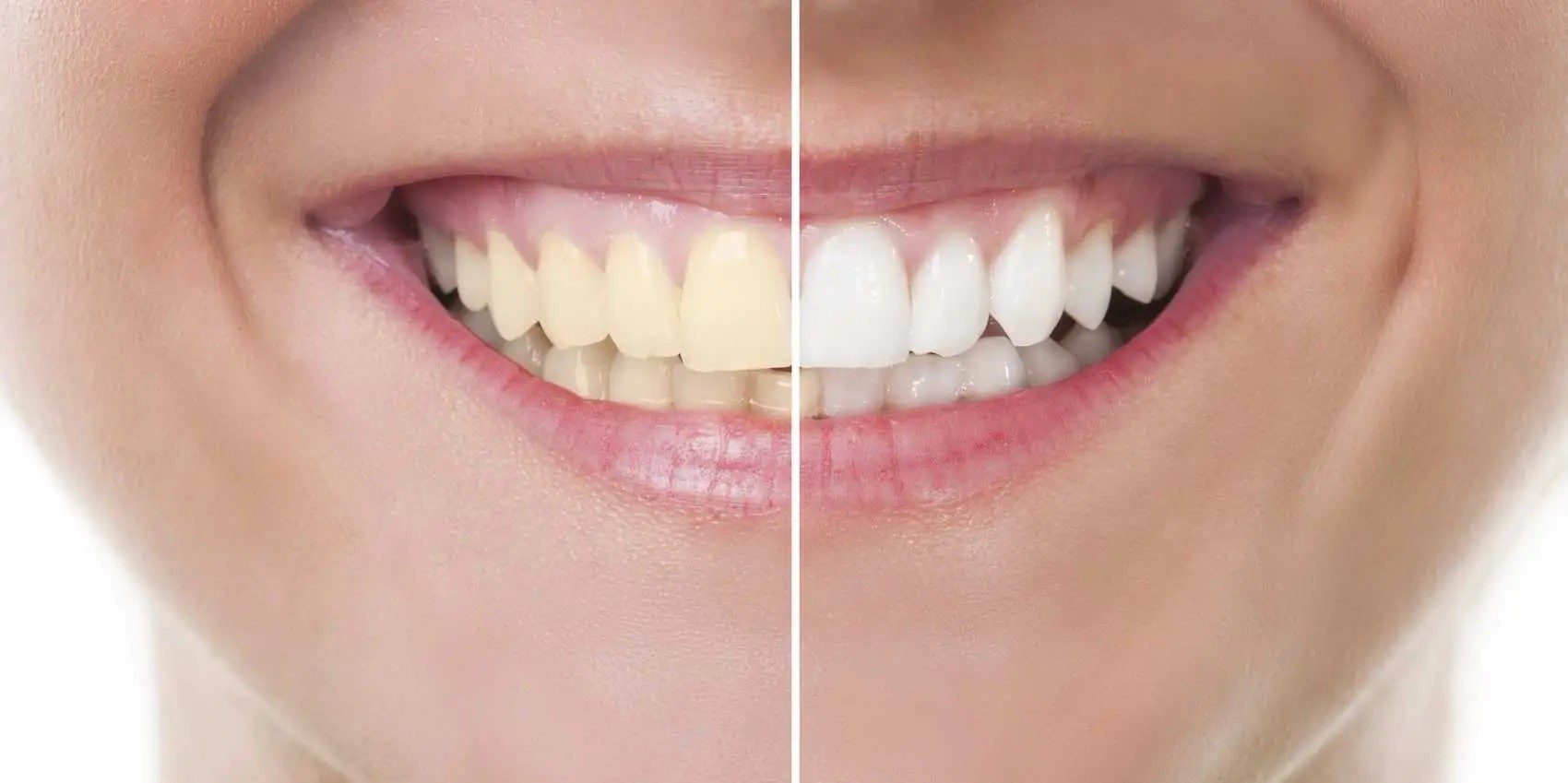 A Dentist Takes on Whitening Toothpastes, the Best Way to Whiten Teeth
