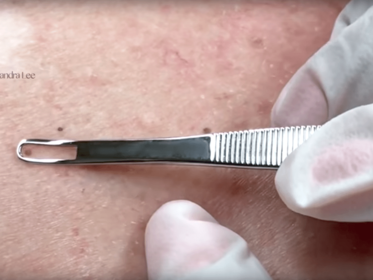Watch Dr. Pimple Popper&rsquo;s New Blackhead Removal Video - Business 