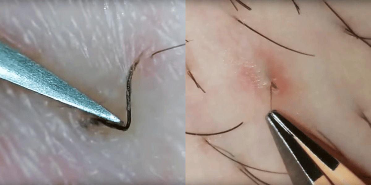 The Best IngrownHairRemoval Videos