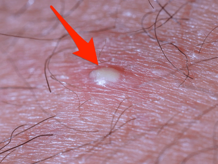 How To Get Rid Of Ingrown Hairs