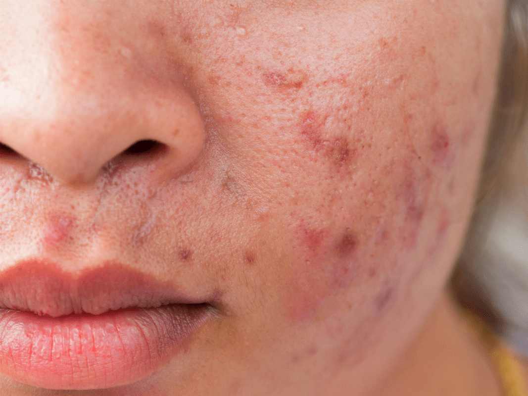 Foods That Might Be Giving You Acne Business Insider