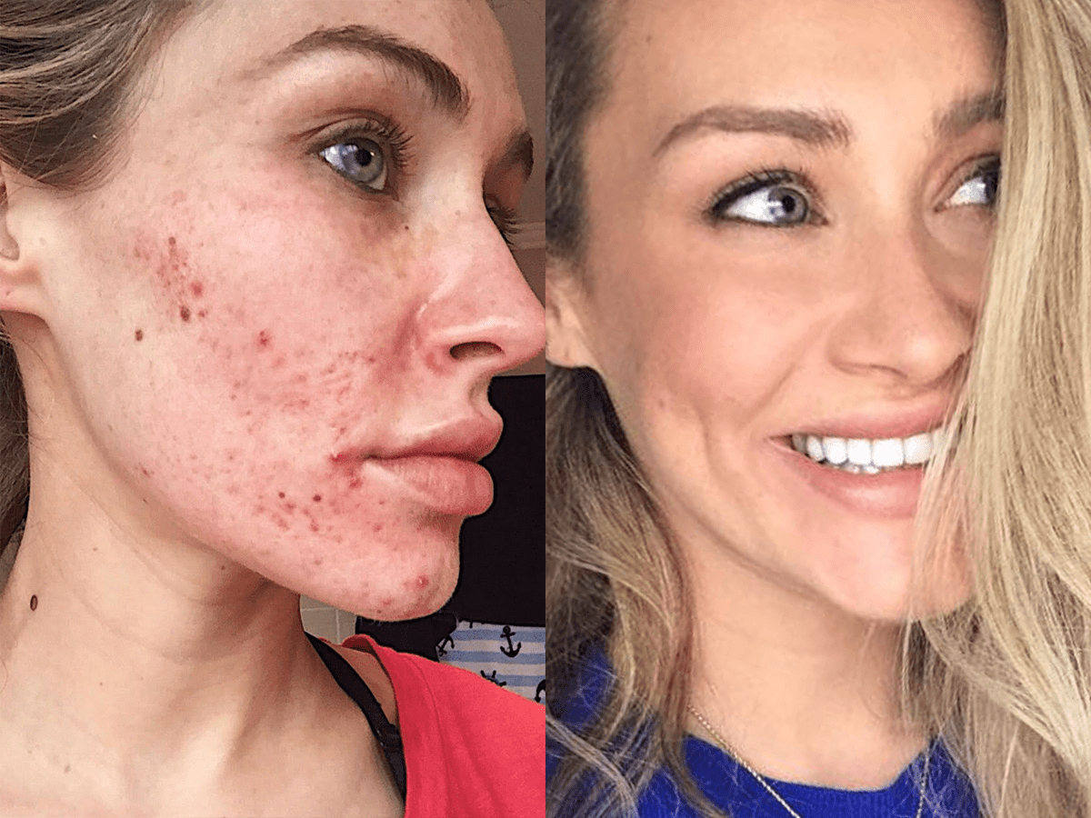 A Woman Tried the Pixel Acne Treatment and Had a Painful Experience