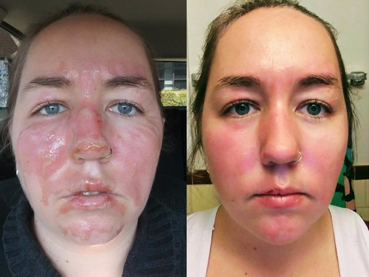 Woman Photos Show the Healing Process of SecondDegree Burns Business