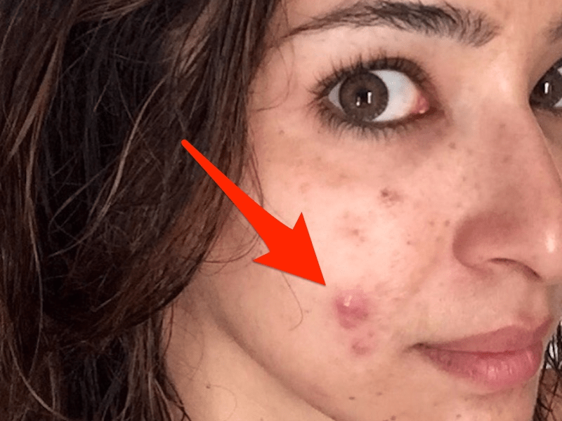 Acne Nodules On Face