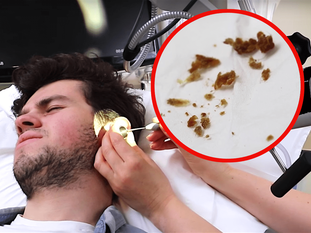 Doctor Uses Microsuction Vacuum to Remove Earwax Business Insider