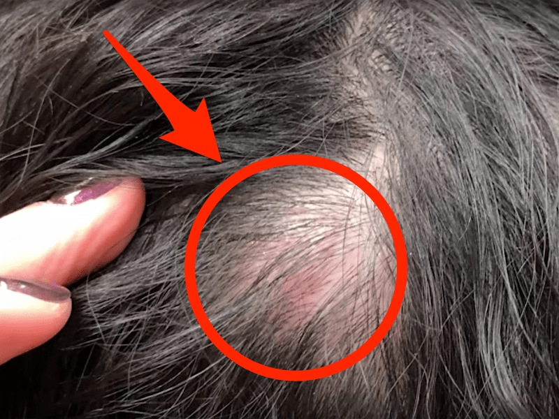Dr. Pimple Popper Removes A Pilar Cyst From A Woman's Head