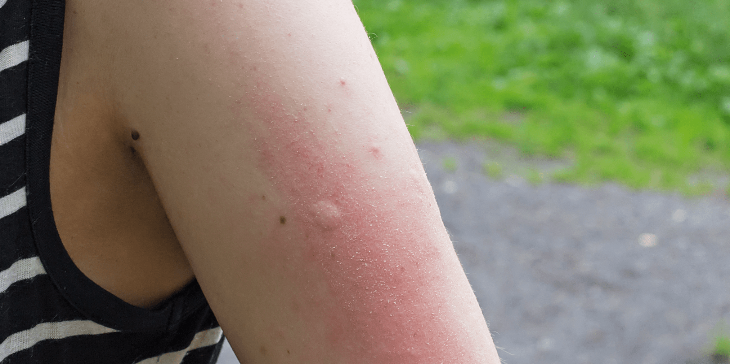 Signs a Bug Bite Is Serious — Warning Signs