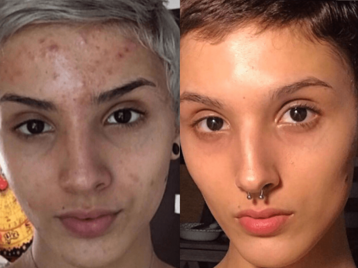 Woman Says Retinol Cleared Her Skin — See Her BeforeandAfter Photos