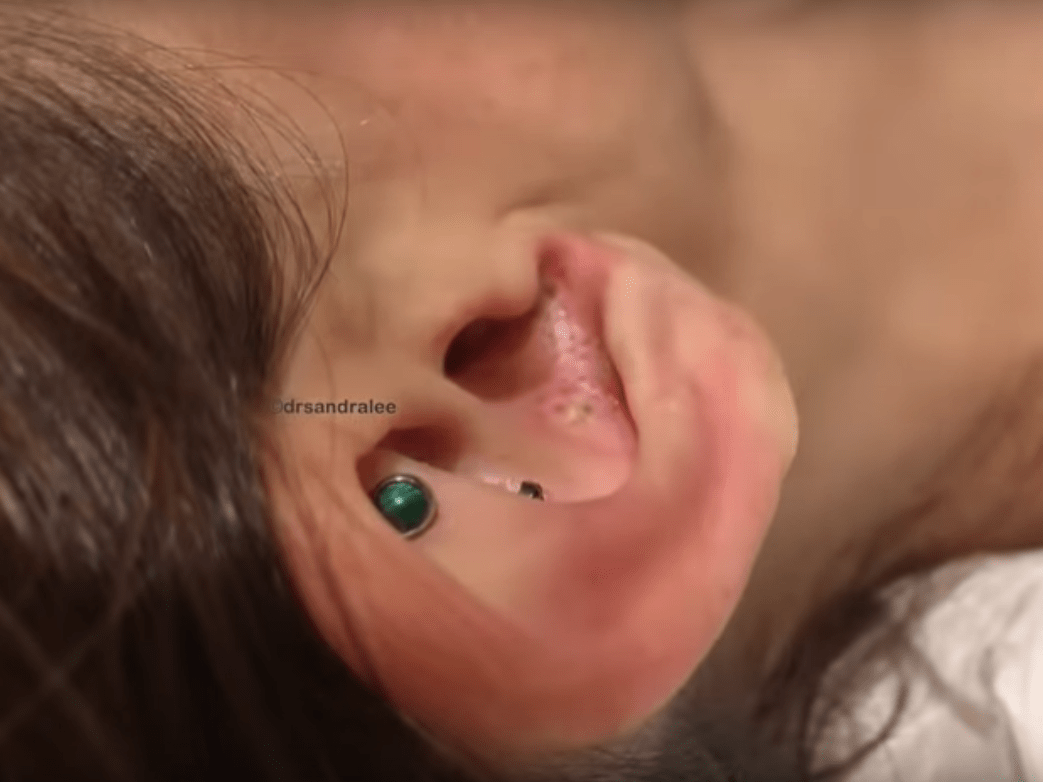 Dr. Pimple Popper Released Ear Blackhead Compilation Video